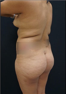 Buttock Lift with Augmentation Before Photo by Johnny Franco, MD; Austin, TX - Case 44288