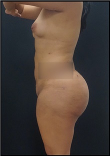 Buttock Lift with Augmentation After Photo by Johnny Franco, MD; Austin, TX - Case 44288