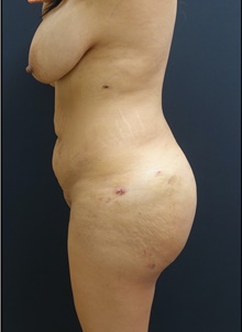 Buttock Lift with Augmentation After Photo by Johnny Franco, MD; Austin, TX - Case 44290