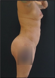 Buttock Lift with Augmentation After Photo by Johnny Franco, MD; Austin, TX - Case 44291