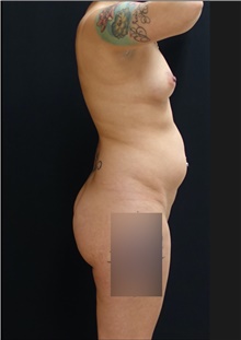 Buttock Lift with Augmentation Before Photo by Johnny Franco, MD; Austin, TX - Case 44291