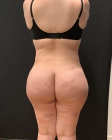 Buttock Lift with Augmentation After Photo by Johnny Franco, MD; Austin, TX - Case 45414