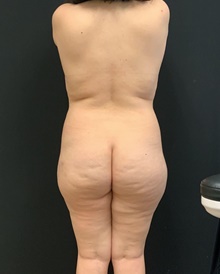 Buttock Lift with Augmentation Before Photo by Johnny Franco, MD; Austin, TX - Case 45414