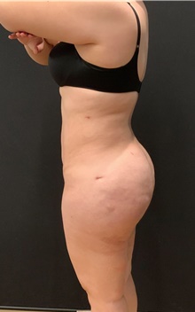 Buttock Lift with Augmentation After Photo by Johnny Franco, MD; Austin, TX - Case 45414