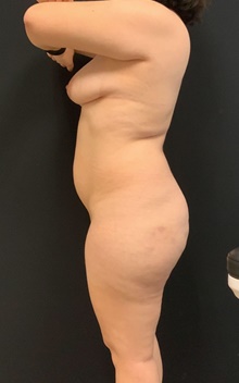 Buttock Lift with Augmentation Before Photo by Johnny Franco, MD; Austin, TX - Case 45414