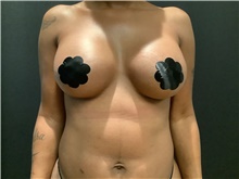 Breast Augmentation After Photo by Johnny Franco, MD; Austin, TX - Case 45433