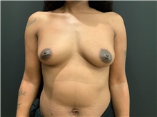 Breast Augmentation Before Photo by Johnny Franco, MD; Austin, TX - Case 45433