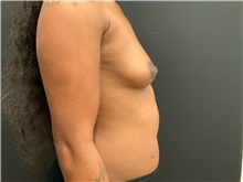 Breast Augmentation Before Photo by Johnny Franco, MD; Austin, TX - Case 45433