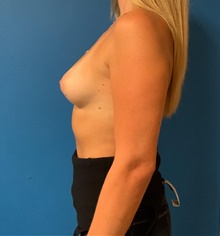 Breast Augmentation Before Photo by Johnny Franco, MD; Austin, TX - Case 45434