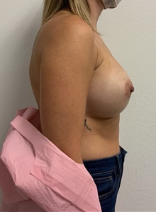 Breast Augmentation After Photo by Johnny Franco, MD; Austin, TX - Case 45437