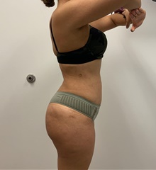 Buttock Lift with Augmentation After Photo by Johnny Franco, MD; Austin, TX - Case 45442