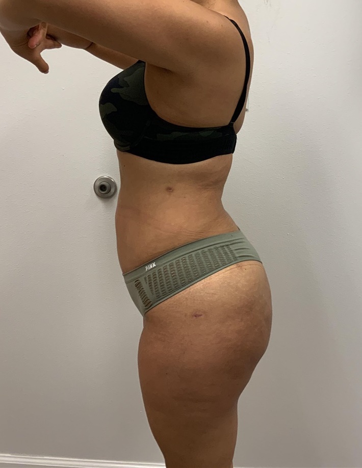Buttock Lift with Augmentation Before and After Photos by Johnny