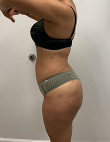 Buttock Lift with Augmentation After Photo by Johnny Franco, MD; Austin, TX - Case 45442