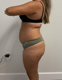 Buttock Lift with Augmentation Before Photo by Johnny Franco, MD; Austin, TX - Case 45442