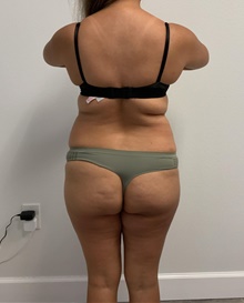 Buttock Lift with Augmentation Before Photo by Johnny Franco, MD; Austin, TX - Case 45442