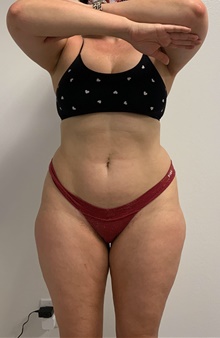 Buttock Lift with Augmentation Before Photo by Johnny Franco, MD; Austin, TX - Case 45462
