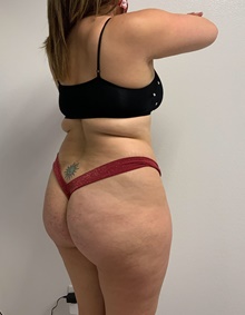 Buttock Lift with Augmentation Before Photo by Johnny Franco, MD; Austin, TX - Case 45462