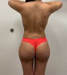 Buttock Lift with Augmentation After Photo by Johnny Franco, MD; Austin, TX - Case 45613