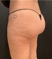 Buttock Implants After Photo by Johnny Franco, MD; Austin, TX - Case 45614