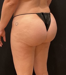Buttock Implants Before Photo by Johnny Franco, MD; Austin, TX - Case 45614