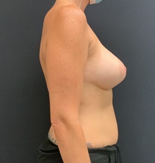Breast Augmentation After Photo by Johnny Franco, MD; Austin, TX - Case 45652