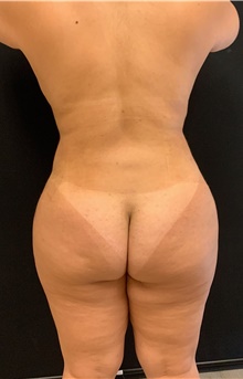 Buttock Lift with Augmentation After Photo by Johnny Franco, MD; Austin, TX - Case 45665