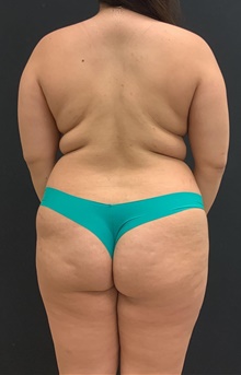 Buttock Lift with Augmentation Before Photo by Johnny Franco, MD; Austin, TX - Case 45665