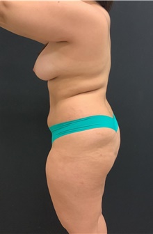 Buttock Lift with Augmentation Before Photo by Johnny Franco, MD; Austin, TX - Case 45665