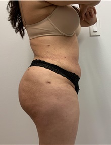 Buttock Lift with Augmentation After Photo by Johnny Franco, MD; Austin, TX - Case 45666