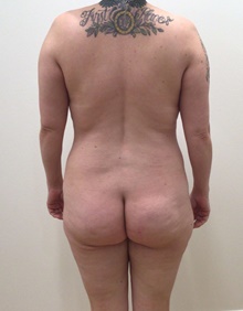 Buttock Lift with Augmentation Before Photo by Johnny Franco, MD; Austin, TX - Case 45667
