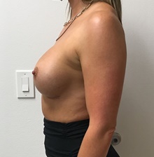 Breast Augmentation After Photo by Johnny Franco, MD; Austin, TX - Case 45681