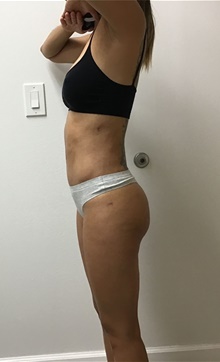 Buttock Lift with Augmentation After Photo by Johnny Franco, MD; Austin, TX - Case 45682