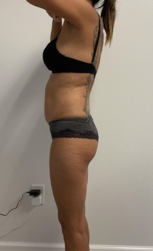 Buttock Lift with Augmentation Before Photo by Johnny Franco, MD; Austin, TX - Case 45682