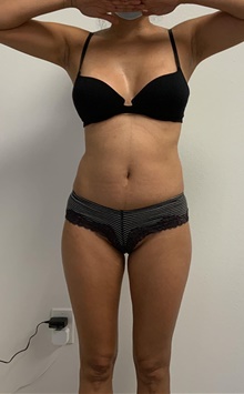 Buttock Lift with Augmentation Before Photo by Johnny Franco, MD; Austin, TX - Case 45682