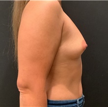 Breast Augmentation Before Photo by Johnny Franco, MD; Austin, TX - Case 45701
