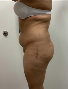 Buttock Lift with Augmentation Before Photo by Johnny Franco, MD; Austin, TX - Case 45702