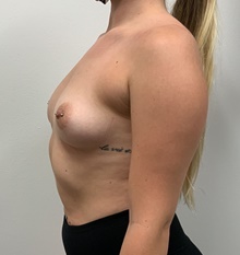 Breast Augmentation Before Photo by Johnny Franco, MD; Austin, TX - Case 45717
