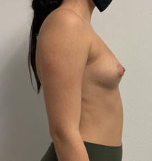 Breast Augmentation Before Photo by Johnny Franco, MD; Austin, TX - Case 45718