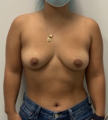 Breast Augmentation Before Photo by Johnny Franco, MD; Austin, TX - Case 45721