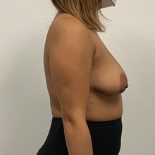 Breast Lift Before Photo by Johnny Franco, MD; Austin, TX - Case 45724