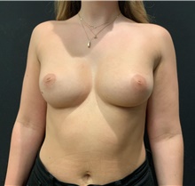 Breast Augmentation Before Photo by Johnny Franco, MD; Austin, TX - Case 45727