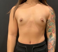 Breast Augmentation Before Photo by Johnny Franco, MD; Austin, TX - Case 45729