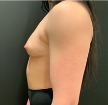 Breast Augmentation Before Photo by Johnny Franco, MD; Austin, TX - Case 45730