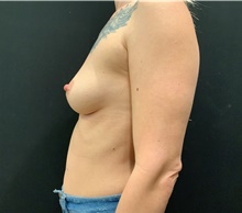 Breast Augmentation Before Photo by Johnny Franco, MD; Austin, TX - Case 45731