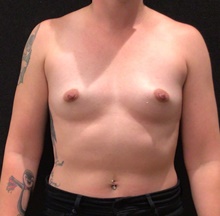 Breast Augmentation Before Photo by Johnny Franco, MD; Austin, TX - Case 45733