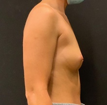 Breast Augmentation Before Photo by Johnny Franco, MD; Austin, TX - Case 45736