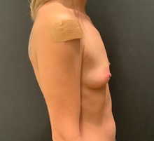 Breast Augmentation Before Photo by Johnny Franco, MD; Austin, TX - Case 45738