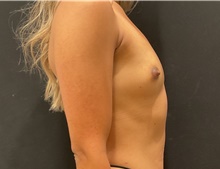 Breast Augmentation Before Photo by Johnny Franco, MD; Austin, TX - Case 45745