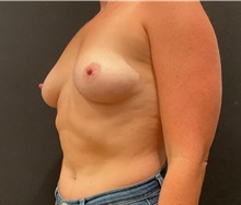 Breast Augmentation Before Photo by Johnny Franco, MD; Austin, TX - Case 45746