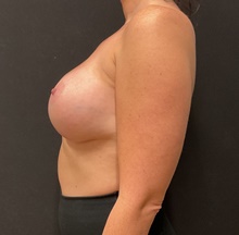 Breast Augmentation After Photo by Johnny Franco, MD; Austin, TX - Case 45746